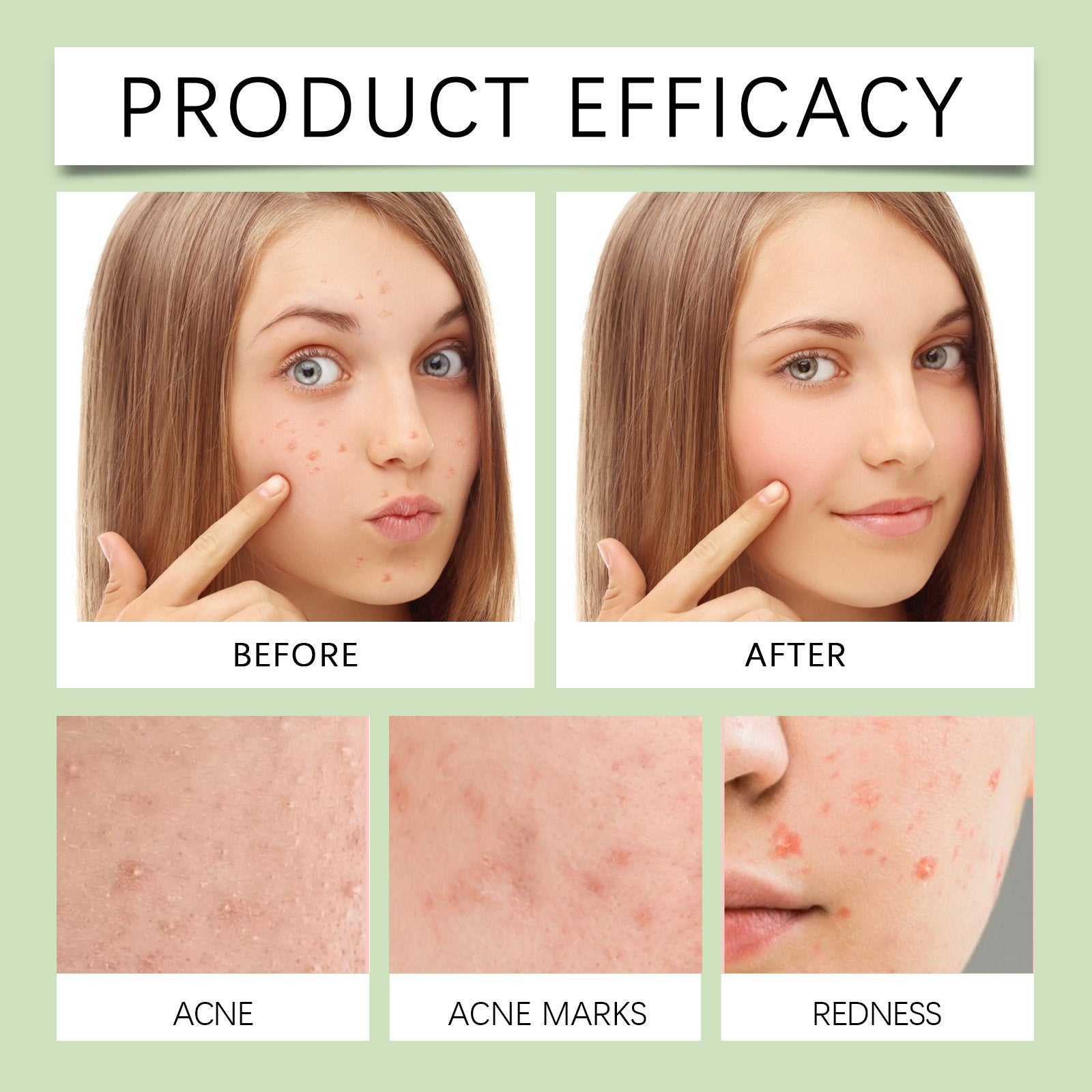 Acne Patch for Blemish Care